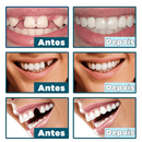 SmileWhite  - Par de Facetas Dentárias Naturais (MOLDE AJUSTÁVEL!)