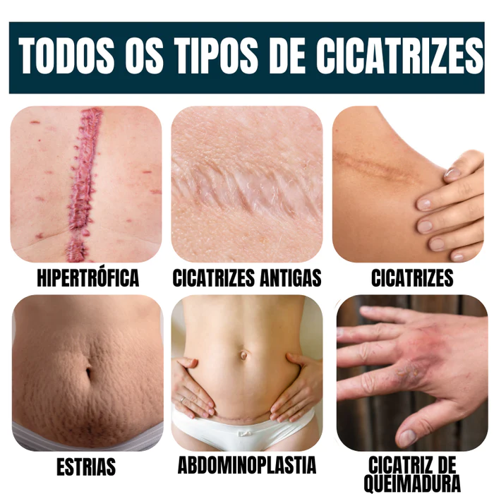 Gel Scar® 100% Advanced Gel